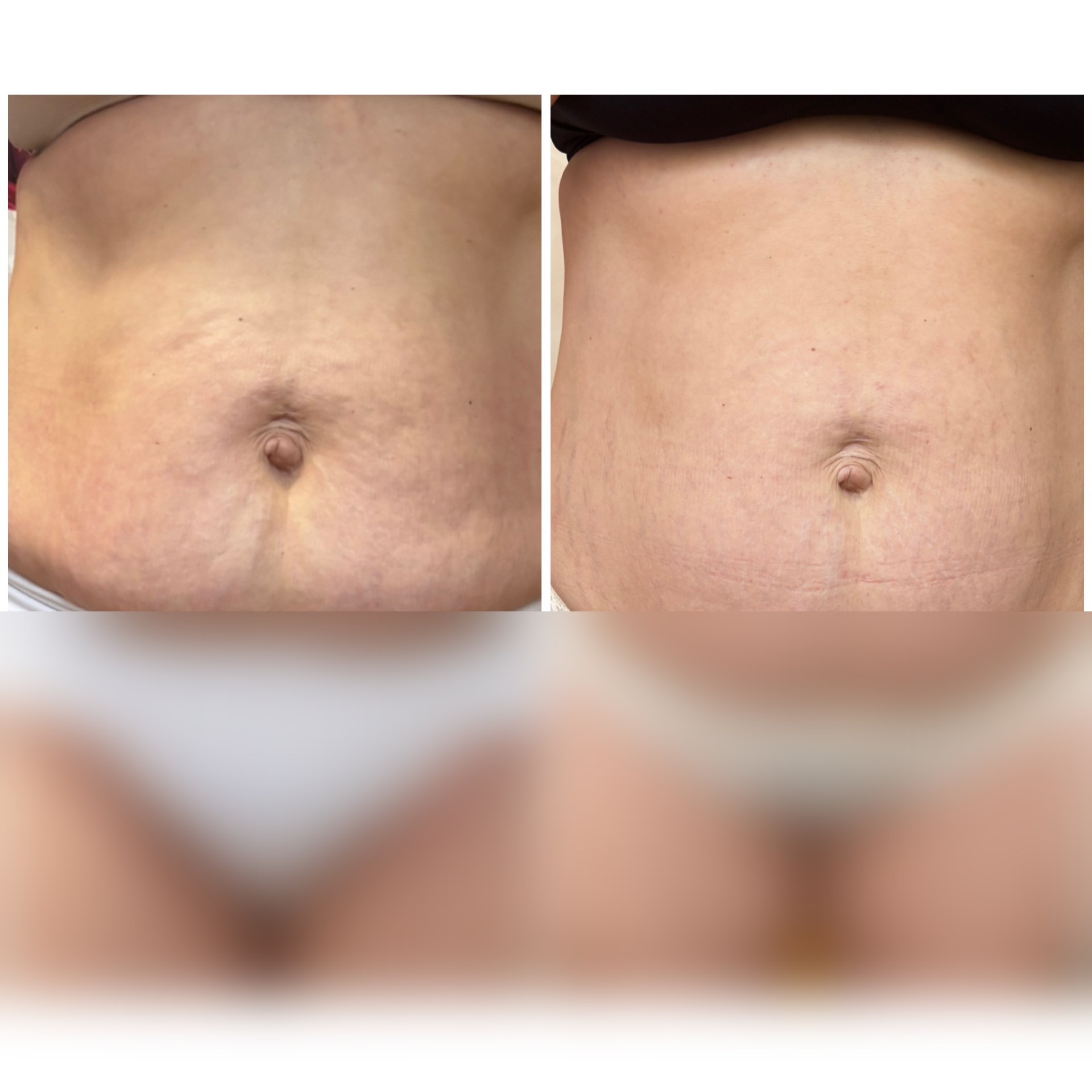 Body Wrapping eredmény a köldök feletti terület kezelése után