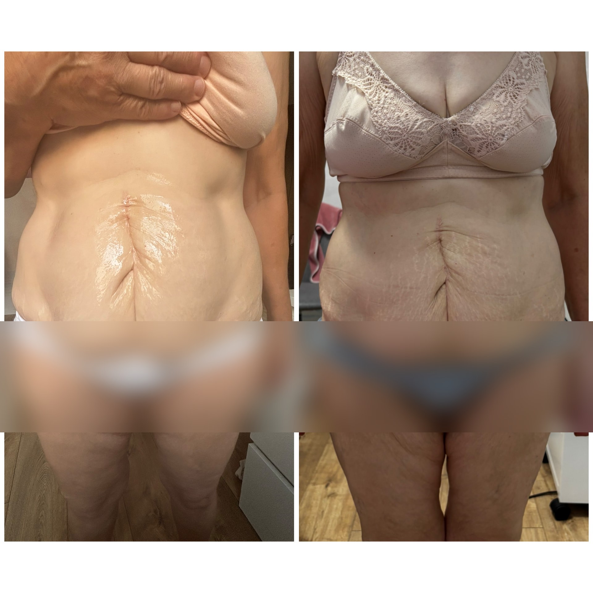 Body Wrapping kúra előtte-utána eredmény a has területén, 10 alkalom után