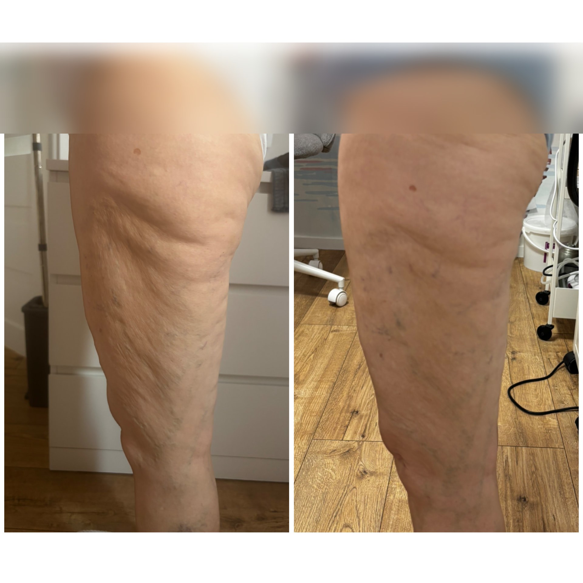 Body Wrapping kúra előtte-utána eredmény a comb területén, 10 alkalom után